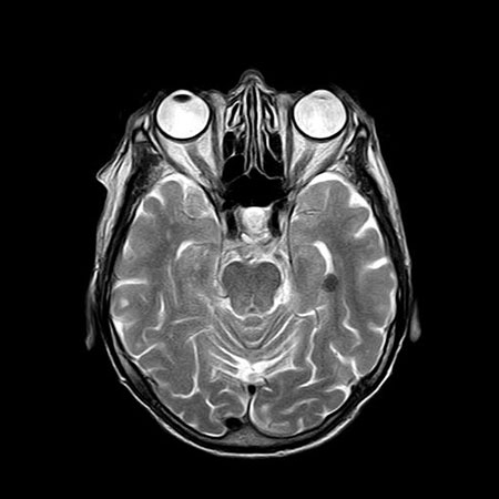 MRI image related to traumatic brain injury claim